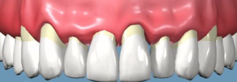 Piorrea o enfermedad periodontal