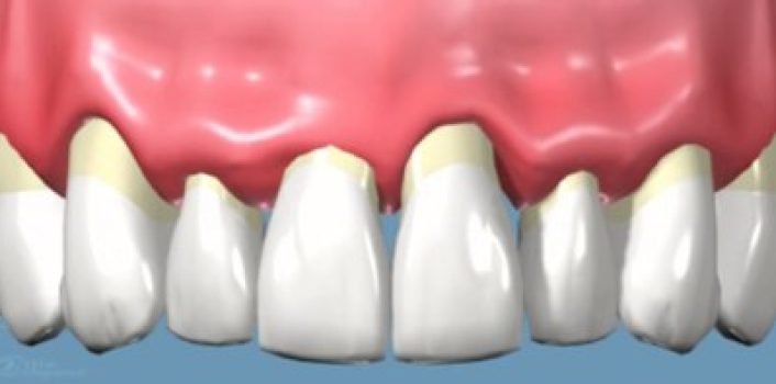 Piorrea o enfermedad periodontal