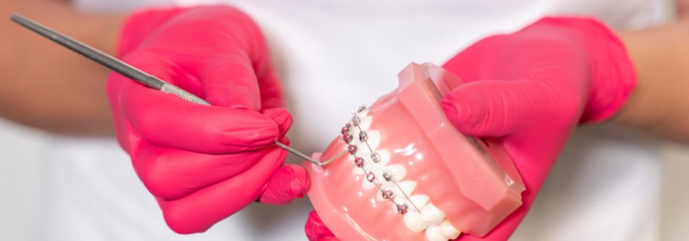 ¿Son compatibles los implantes dentales y la ortodoncia?